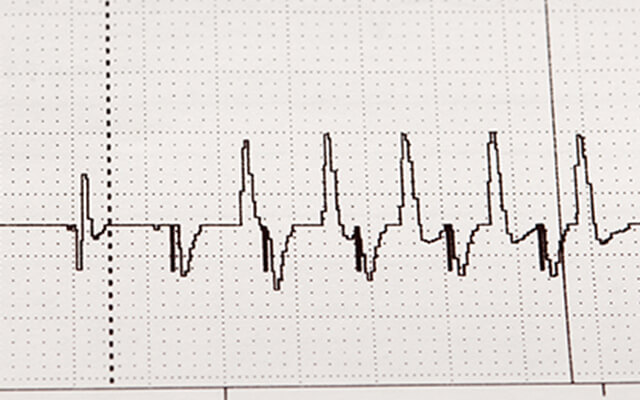 cardiovascular research - arrythmia image