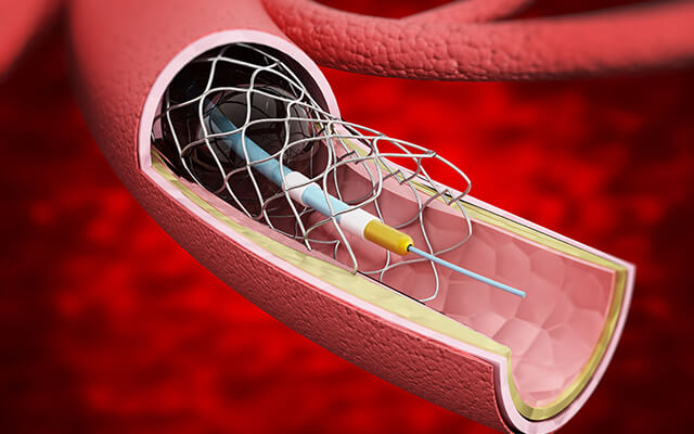 cardiovascular research - catheter inside artery