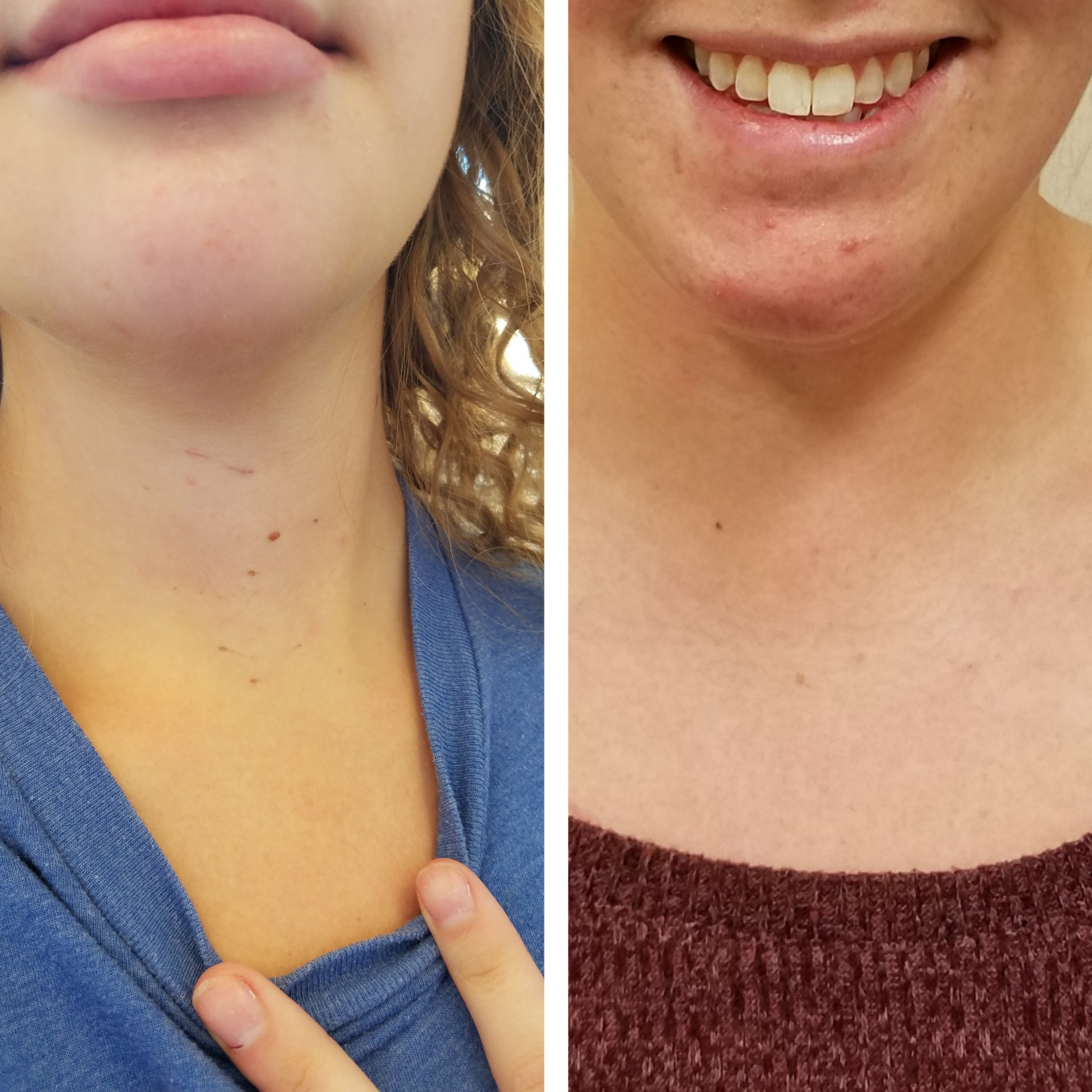 Two women show no scarring on their necks after thyroidectemy.