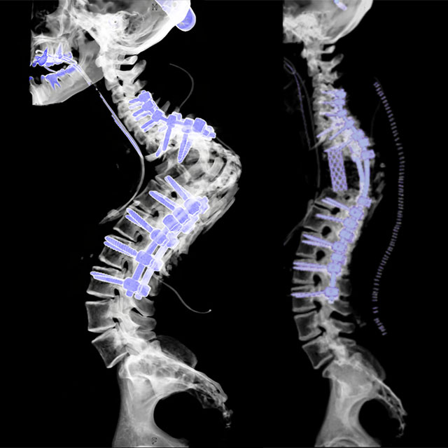 The CT scan on the left shows very severe thoracic kyphosis. The instrumentation has been placed proximal and distal to apex of the deformity in preparation for the vertebral resection.The image on the right shows a CT scan of the spine after multiple vertebrae were resected. Reconstruction was done using a long titanium mesh cage and bone graft.