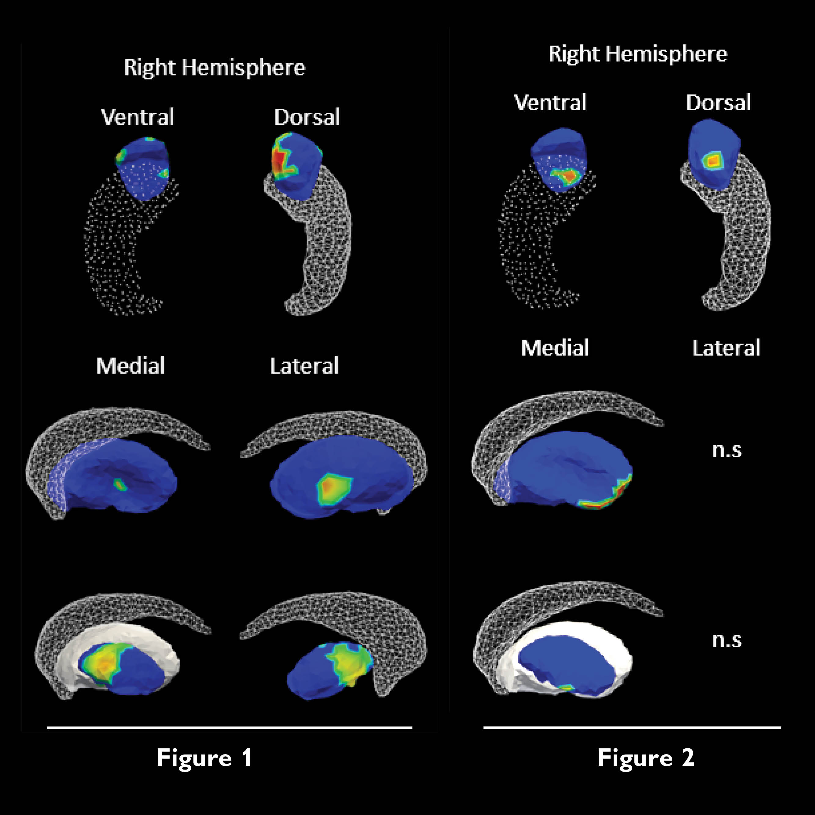 The image shows the shape compression of various structures in the brain related to emotion regulation in ADHD compared with typically developing boys and the brain-behavior correlations for ADHD boys between emotion dysregulation and regions of expansion on the amygdala, putamen and globus pallidus. 