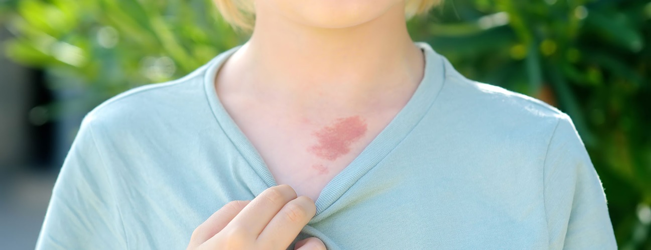 child pulls the collar of their shirt down to reveal a birthmark
