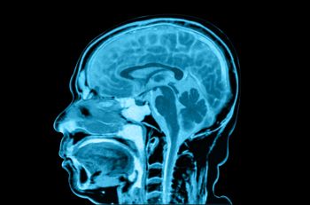 MRI scan of the brain