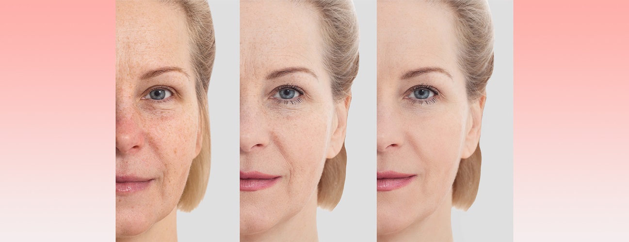 Close-up image of a woman’s face showing before-and-after cosmetic treatment.