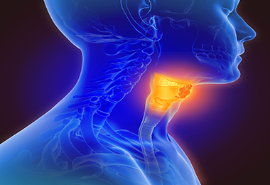 illustration of throat cancer