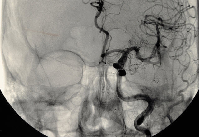 aneurysm image