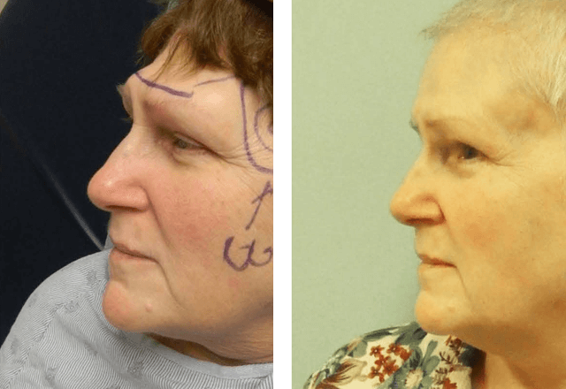 Before and after cranioplasty
