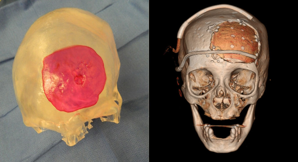 Skull with custom cranial implant