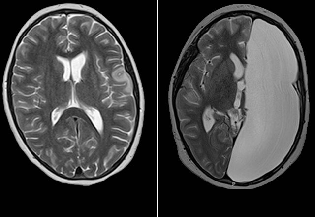 Before and after treatment brain MRI