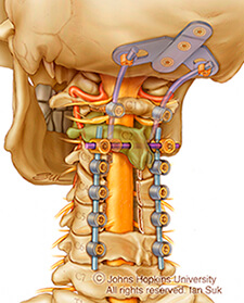 illustration of the upper spine and skull with surgical appliance