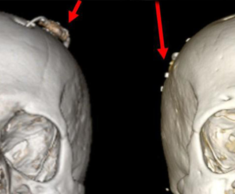 Comparison of a high-profile shunt on the left contrasted with a low-profile one on the right