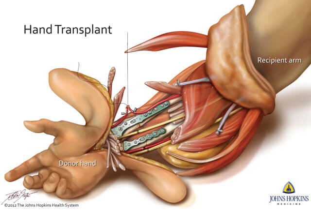 hand transplant illustration