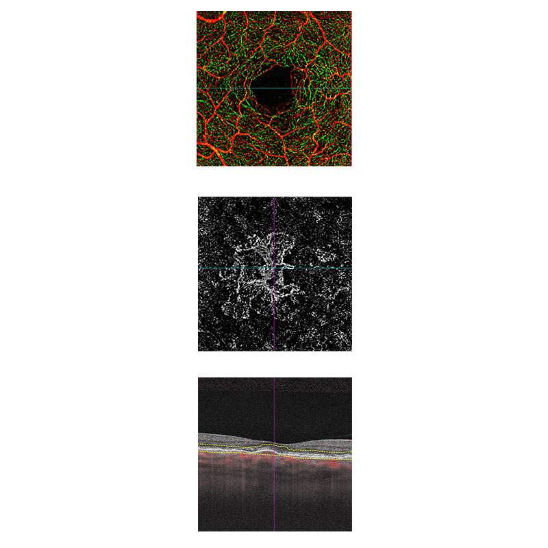OCTA images of Neovascular age related macular degeneration