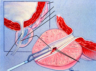 Transurethral resection of the ejaculatory ducts