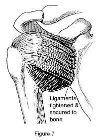 Diagram showing ligaments tightened and secured to bone