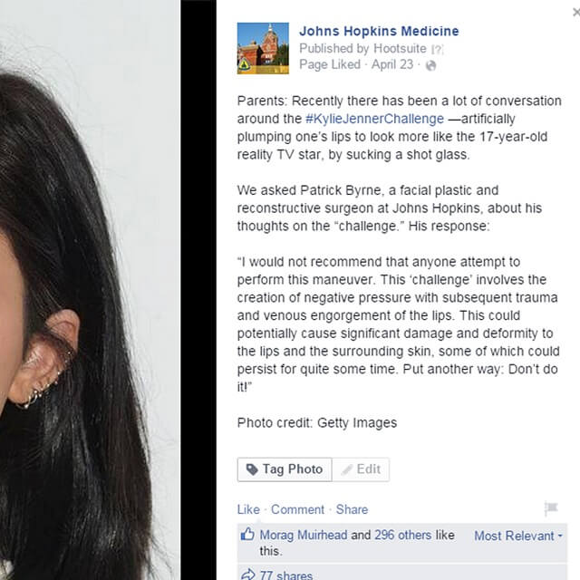 This Facebook post was about a trending topic—the Kylie Jenner Challenge—with commentary from a surgeon at Johns Hopkins Medicine.