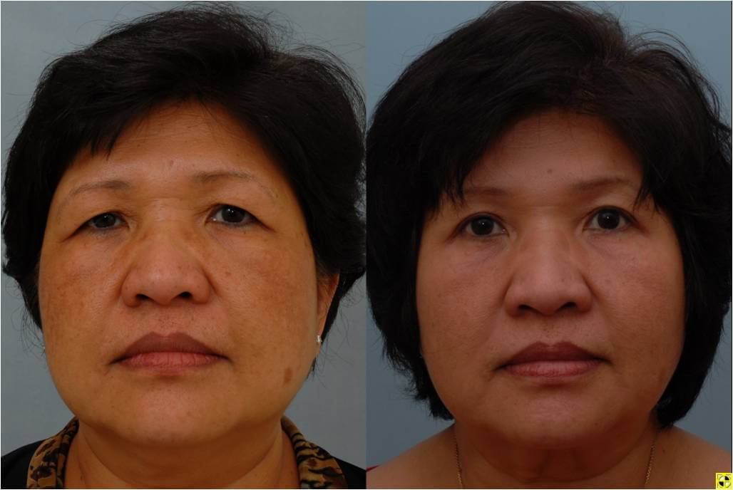What are the costs of eyelid surgery?