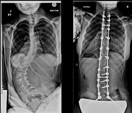 X-rays showing severe scoliosis in a patient with cerebral palsy before and after treatment