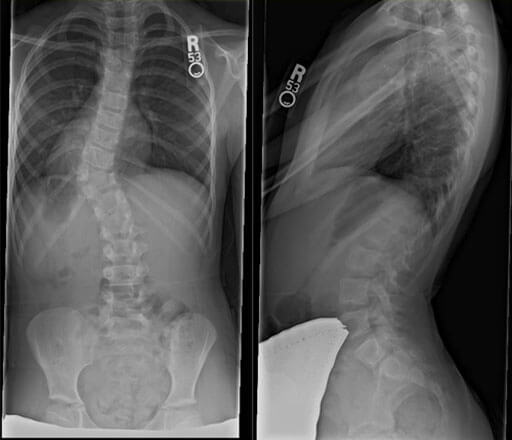 Congenital scoliosis preoperative X-rays showing severe spine curvature from the back and side