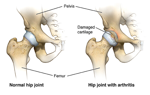 What types of activities are performed during hip replacement rehabilitation?