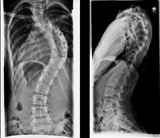 X-rays of a patient with adolescent idiopathic scoliosis showing curvature of the spine