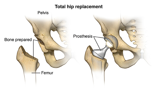 Is leg swelling a possible complication following hip replacement?