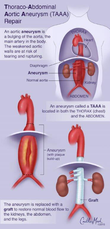 What are the causes of an enlarged abdominal aorta?
