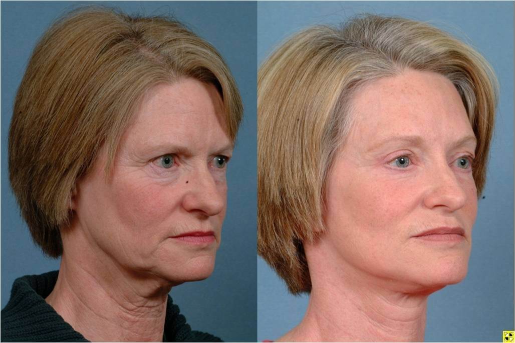 How much does a QuickLift facelift usually cost?