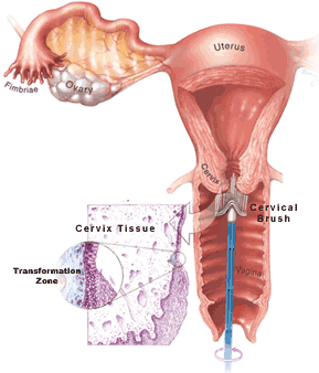 cervix dysplasia