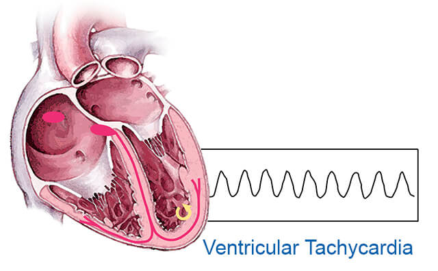 Ventricular Tachycardia | Johns Hopkins Medicine Health Library