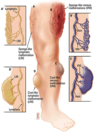 Arteriovenous Malformation Treatment In India