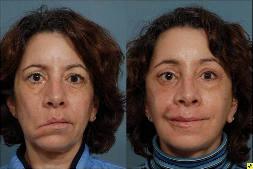 Facial palsy or aging