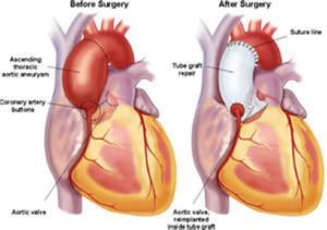 Illustration of before and after heart surgery