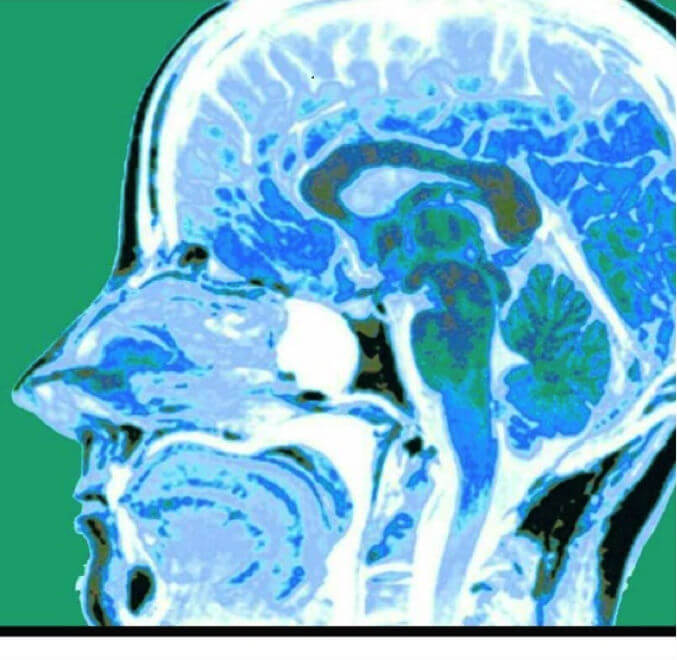 MRI scan showing medulloblastoma