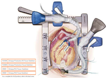 illustration of a off-pump coronary artery bypass