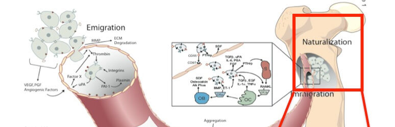 Diagram of prostate cancer metastasis within a bone