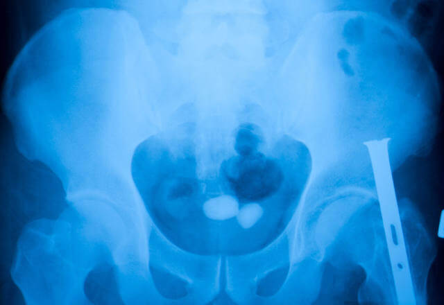 Pelvic x-ray showing stones