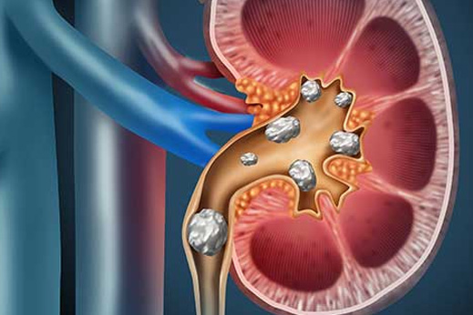 Kidney stones inside a kidney.