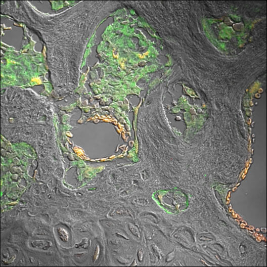 The image is a differential interference contrast (DIC) microscopy photograph overlaid with PCa cells stained green