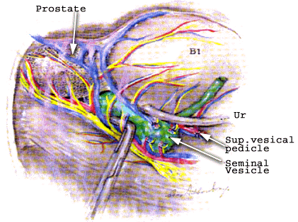 Image diagramming the location of the superior vesical pedicle and seminal vesicle