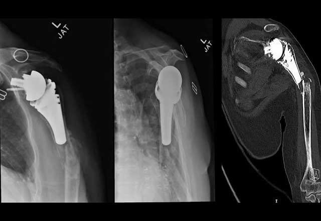 Three views from a shoulder X-ray showing a fracture below the reverse total shoulder replacement prosthesis
