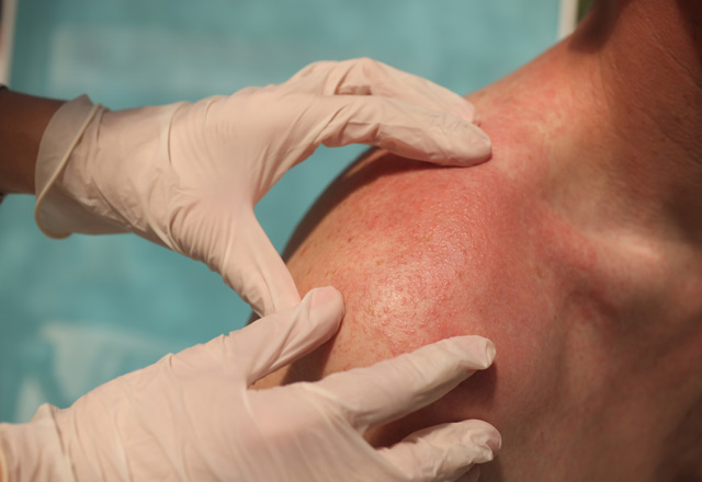 Dermatologist examining patient's shoulder with dermatomyositis