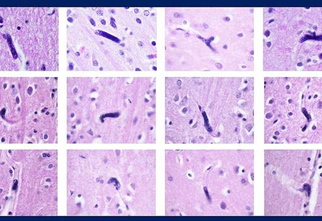 megakaryocytes