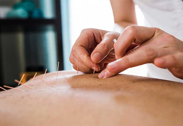 Woman at an acupuncture appointment.