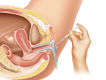 Intrauterine insemination graphic