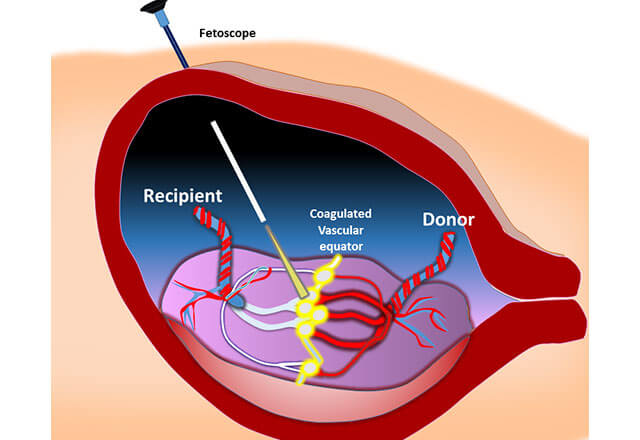 Diagram showing a fetoscope inserted into the uterus to correct twin-to-twin transfusion syndrome.