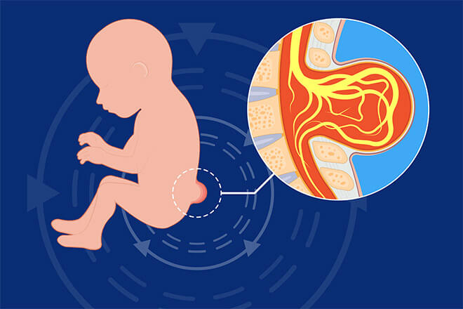 Illustration of fetus with spina bifida