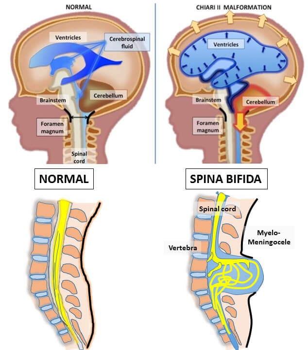 Spina bifida illustration