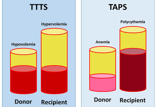 Illustration of blood flow in TTTS and TAPS