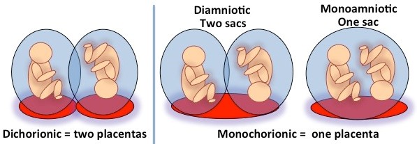 Illustration of dichorionic (two placenta) and monochorionic (one placenta) twin pregnancies.